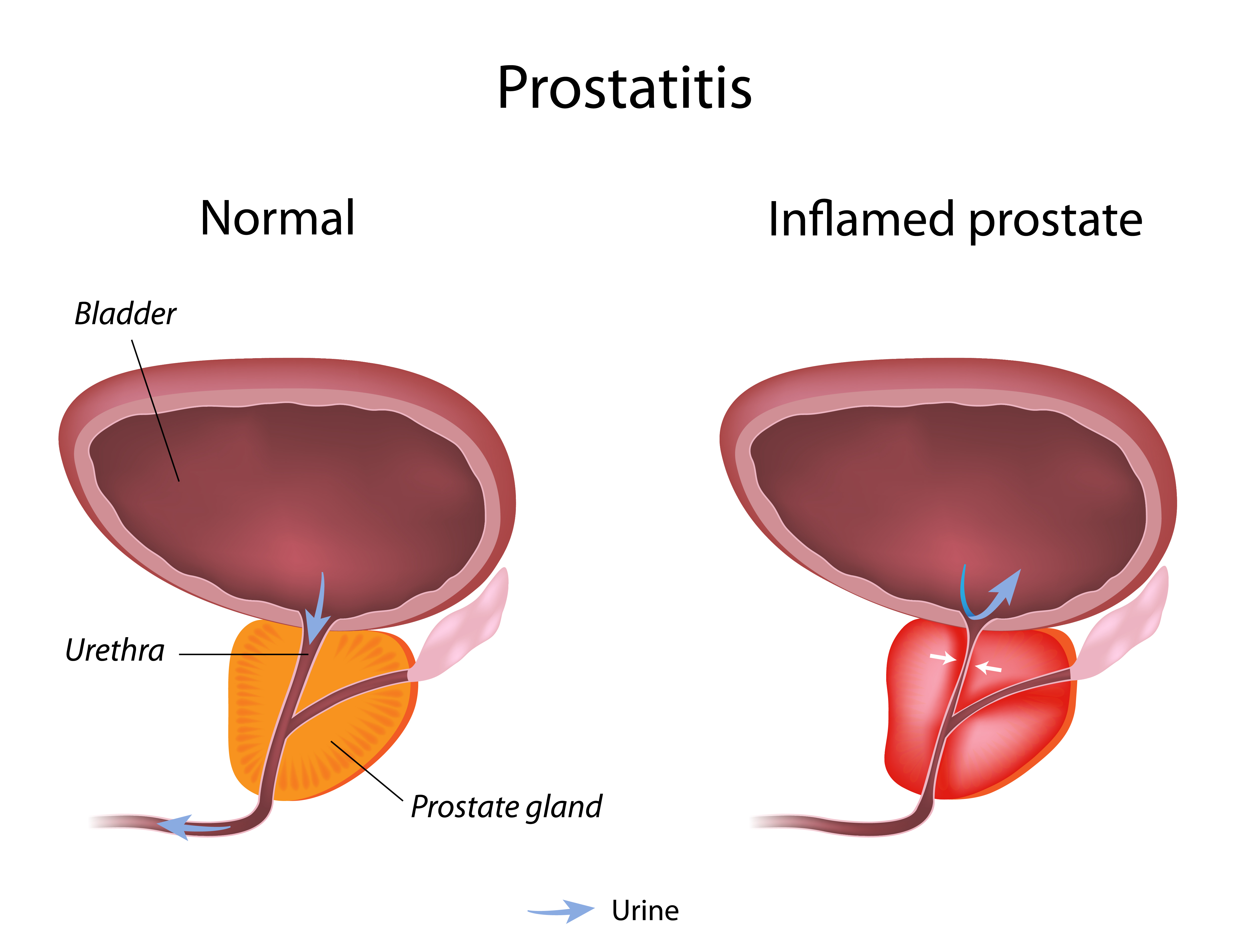 prostatitis a férfiaknál ahol van